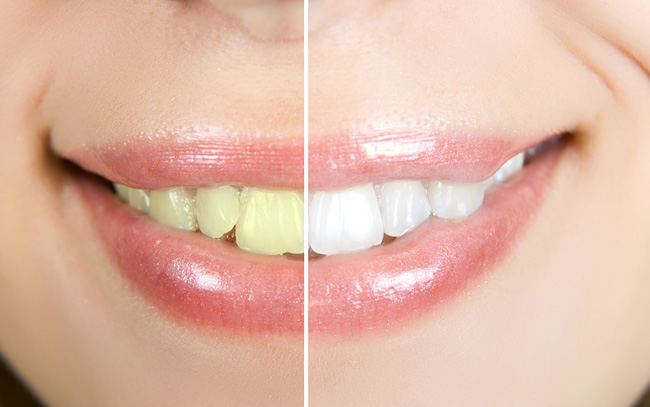 tandblekning - före och efter bild